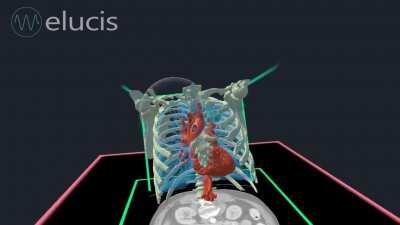 Quickly segmenting a CT and viewing precision 3D models in virtual reality