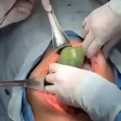 Dumb ass gets a huge cucumber removed as a prize from his rectum after stuffing it up his Anus