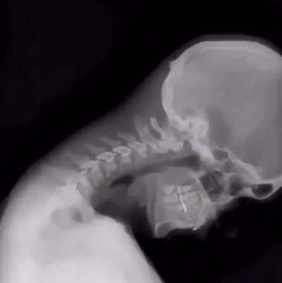 Dynamic Digital Radiography (DDR) allows you to observe movement like never before.