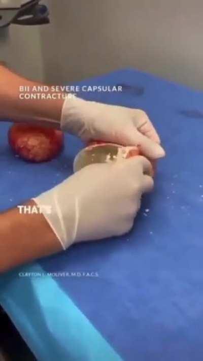 An Excised Encapsulated Breast Implant