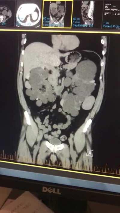 Polycystic kidneys anyone?