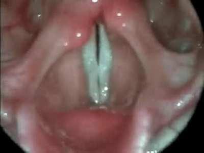 Vocal cords in action