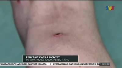 MPOX Cases in SEA as per July 2024: SG (42) TH (400) PH (10) MY(0)