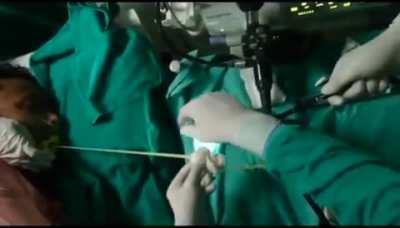 Pulling out a 6-ft pork tapeworm through a man's mouth