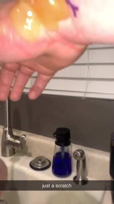 My friend burned his hand with gas on accident ! He says “just a scratch” that look like it hurt 🤣