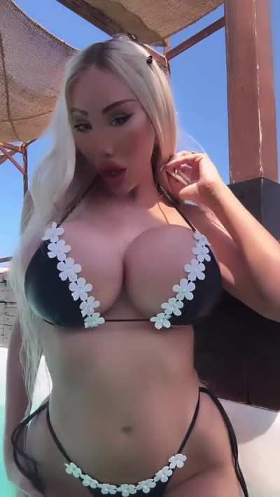 2025 and now recovering from my custom printed cheekbone revision surgery. You can see my swollen face in the end