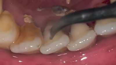 Вопрос к дантистам: что это такое, и как сильно нужно игнорить чистку зубов чтоб такое появилось??