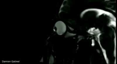 Трём глаза на МРТ