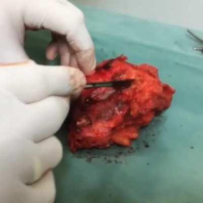 Pulsating tumor! This sarcoma was excised with a piece of muscle from the leg of a 46 year-old woman and was presented as a pulsating tumor while the surgeon tried to cut it open!