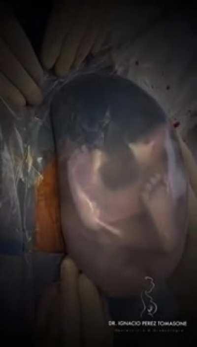It's Crazy Seeing A Human Born Like This With The Sac Intact!