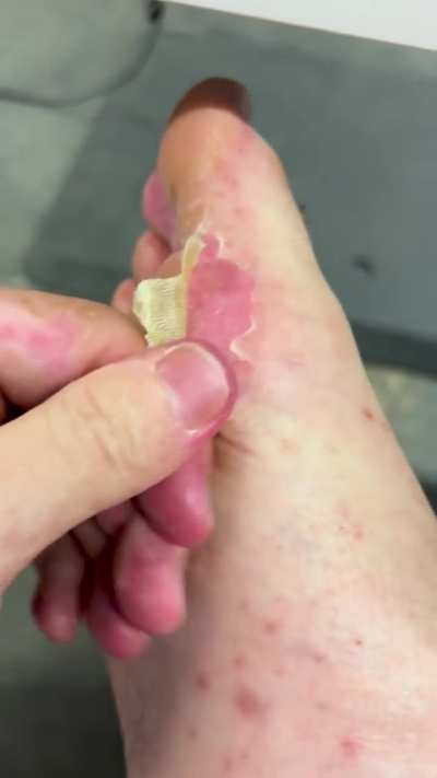 Peeling from hand foot and mouth disease