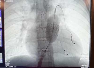 Patient Required Open Heart Surgery to Remove Valve