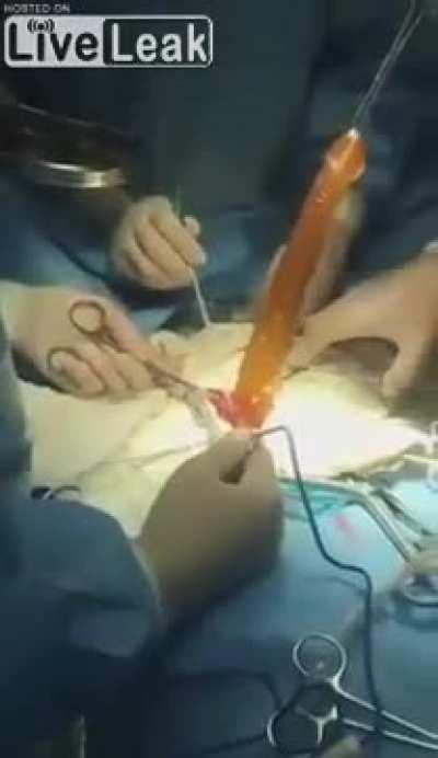 pulling a large dildo out of a man's intestines 