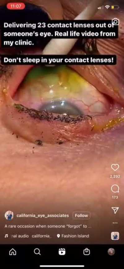 23 contact lenses being removed from an eyeball