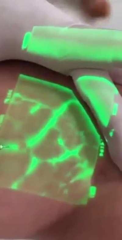 VeinViewer is a technology that helps physicians and nurses see a patient's veins.