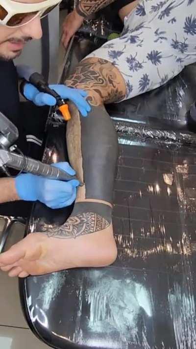 This tattoo removal 
