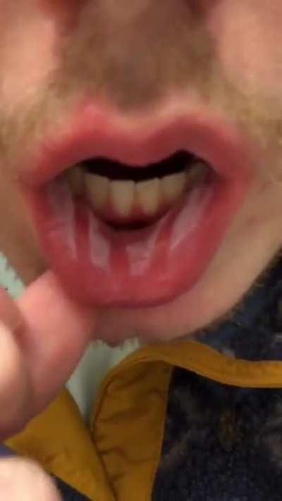 I fucked up so hard. Metal fork used to stir a pot on the stove that was heated to the highest setting. In a moment of utter stupidity I took the fork out of the pot and as I walked it to the sink I mindlessly put it in my mouth to lick the sauce off. I w