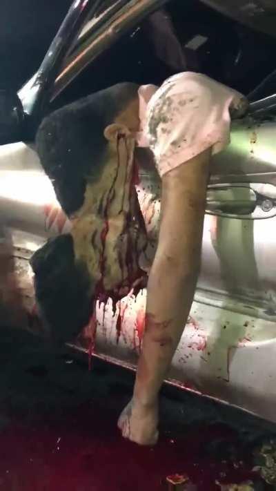 Aftermath of high speed head on with a semi..18+ very graphic. Impacted so hard the skin was ripped out from his skull